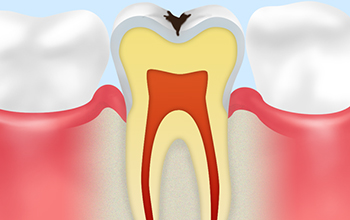 C1エナメル質のむし歯