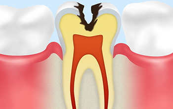 C2象牙質のむし歯