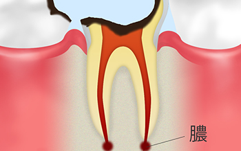 C4歯根に達したむし歯