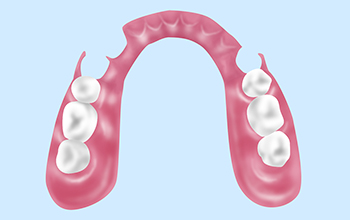 目立たない人気の入れ歯～ノンクラスプデンチャー