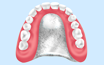 金属床義歯（自費診療）