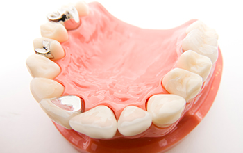 銀歯から解放されるメリット