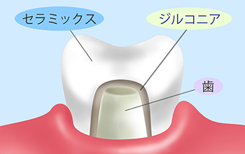 ジルコニア