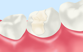 詰めものについて 登戸の歯医者 歯科 中村歯科医院
