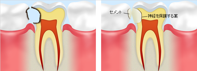 浅いむし歯の場合