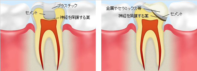 深いむし歯の場合