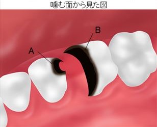 深いむし歯の場合