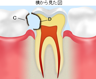 詰めものについて 登戸の歯医者 歯科 中村歯科医院