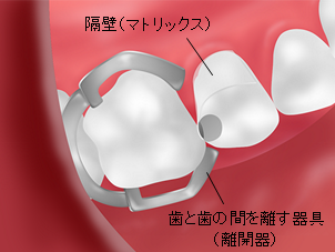 離開器