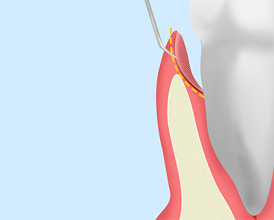 歯周ポケットそうは術